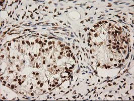 LOX / Lysyl Oxidase Antibody - IHC of paraffin-embedded Adenocarcinoma of Human ovary tissue using anti-LOX mouse monoclonal antibody.