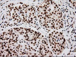 LOX / Lysyl Oxidase Antibody - IHC of paraffin-embedded Carcinoma of Human pancreas tissue using anti-LOX mouse monoclonal antibody.