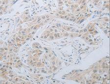LOX / Lysyl Oxidase Antibody - Immunohistochemistry of paraffin-embedded Human lung cancer using LOX Polyclonal Antibody at dilution of 1:30.