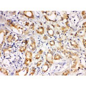 LOXL1 Antibody - LOXL1 antibody IHC-paraffin. IHC(P): Human Prostatic Cancer Tissue.