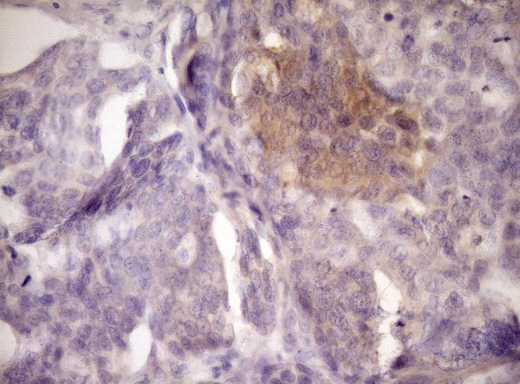 LOXL2 Antibody - Immunohistochemical staining of paraffin-embedded Adenocarcinoma of Human ovary tissue using anti-LOXL2 mouse monoclonal antibody. (Heat-induced epitope retrieval by Tris-EDTA, pH8.0)(1:150)