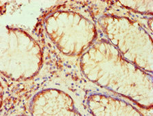LP-PLA2 / PLA2G7 Antibody - Immunohistochemical of paraffin-embedded human colon cancer using PLA2G7 Monoclonal Antibody at dilution of 1:200.