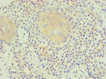 LP-PLA2 / PLA2G7 Antibody - Immunohistochemical of paraffin-embedded human breast cancer using PLA2G7 Monoclonal Antibody at dilution of 1:200.