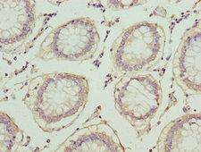 LP-PLA2 / PLA2G7 Antibody - Immunohistochemistry of paraffin-embedded human colon cancer using PLA2G7 Antibody at dilution of 1:100