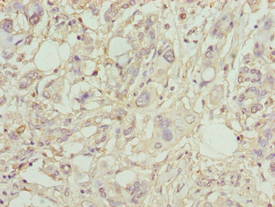 LP-PLA2 / PLA2G7 Antibody - Immunohistochemistry of paraffin-embedded human pancreatic cancer using PLA2G7 Antibody at dilution of 1:100