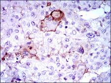 LPA / Lipoprotein a Antibody - IHC of paraffin-embedded liver cancer tissues using LPA mouse monoclonal antibody with DAB staining.