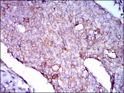 LPA / Lipoprotein a Antibody - IHC of paraffin-embedded breast cancer tissues using LPA mouse monoclonal antibody with DAB staining.