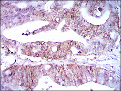 LPA / Lipoprotein a Antibody - IHC of paraffin-embedded rectum cancer tissues using LPA mouse monoclonal antibody with DAB staining.