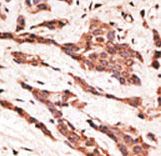 LPAR2 / EDG4 Antibody - Formalin-fixed and paraffin-embedded human cancer tissue reacted with the primary antibody, which was peroxidase-conjugated to the secondary antibody, followed by AEC staining. This data demonstrates the use of this antibody for immunohistochemistry; clinical relevance has not been evaluated. BC = breast carcinoma; HC = hepatocarcinoma.