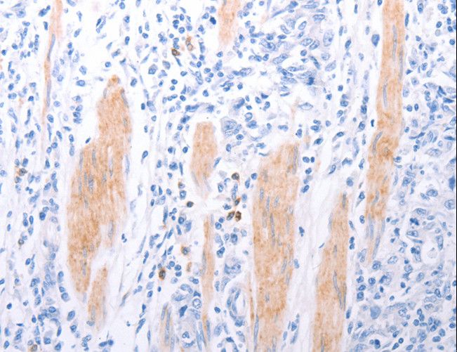LPAR2 / EDG4 Antibody - Immunohistochemistry of paraffin-embedded Human gastric cancer using LPAR2 Polyclonal Antibody at dilution of 1:40.