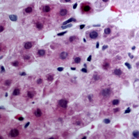 LPAR3 / LPA3 / EDG7 Antibody - Immunohistochemical analysis of EDG7 staining in human liver cancer formalin fixed paraffin embedded tissue section. The section was pre-treated using heat mediated antigen retrieval with sodium citrate buffer (pH 6.0). The section was then incubated with the antibody at room temperature and detected using an HRP conjugated compact polymer system. DAB was used as the chromogen. The section was then counterstained with hematoxylin and mounted with DPX.