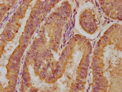 LPAR4 / GPR23 Antibody - IHC image of LPAR4 Antibody diluted at 1:200 and staining in paraffin-embedded human endometrial cancer performed on a Leica BondTM system. After dewaxing and hydration, antigen retrieval was mediated by high pressure in a citrate buffer (pH 6.0). Section was blocked with 10% normal goat serum 30min at RT. Then primary antibody (1% BSA) was incubated at 4°C overnight. The primary is detected by a biotinylated secondary antibody and visualized using an HRP conjugated SP system.