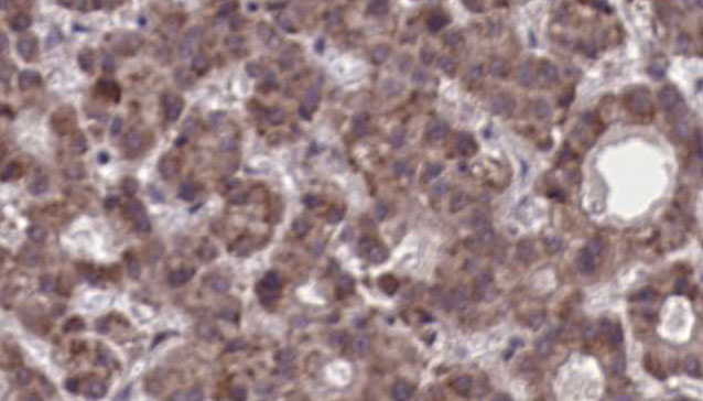 LPAR5 / GPR92 Antibody - 1:100 staining human liver carcinoma tissues by IHC-P. The sample was formaldehyde fixed and a heat mediated antigen retrieval step in citrate buffer was performed. The sample was then blocked and incubated with the antibody for 1.5 hours at 22°C. An HRP conjugated goat anti-rabbit antibody was used as the secondary.