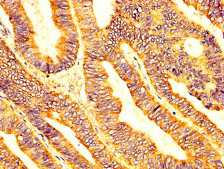 LPCAT2 Antibody - Immunohistochemistry image at a dilution of 1:200 and staining in paraffin-embedded human colon cancer performed on a Leica BondTM system. After dewaxing and hydration, antigen retrieval was mediated by high pressure in a citrate buffer (pH 6.0) . Section was blocked with 10% normal goat serum 30min at RT. Then primary antibody (1% BSA) was incubated at 4 °C overnight. The primary is detected by a biotinylated secondary antibody and visualized using an HRP conjugated SP system.