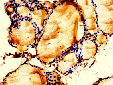LPCAT2 Antibody - Immunohistochemistry image at a dilution of 1:200 and staining in paraffin-embedded human thyroid tissue performed on a Leica BondTM system. After dewaxing and hydration, antigen retrieval was mediated by high pressure in a citrate buffer (pH 6.0) . Section was blocked with 10% normal goat serum 30min at RT. Then primary antibody (1% BSA) was incubated at 4 °C overnight. The primary is detected by a biotinylated secondary antibody and visualized using an HRP conjugated SP system.