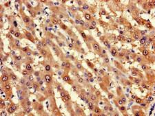 LPGAT1 Antibody - Immunohistochemistry of paraffin-embedded human liver cancer using LPGAT1 Antibody at dilution of 1:100
