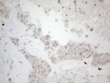 LPIN1 / Lipin 1 Antibody - Immunohistochemical staining of paraffin-embedded Adenocarcinoma of Human endometrium tissue using anti-LPIN1 mouse monoclonal antibody. (Heat-induced epitope retrieval by 1mM EDTA in 10mM Tris buffer. (pH8.5) at 120°C for 3 min. (1:150)