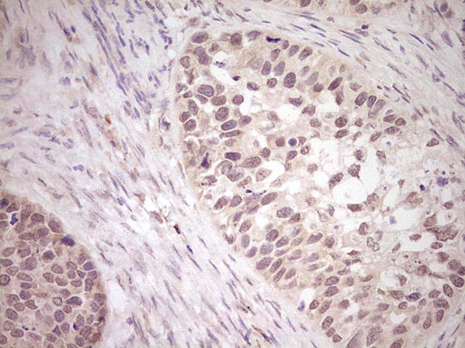 LPIN1 / Lipin 1 Antibody - Immunohistochemical staining of paraffin-embedded Carcinoma of Human kidney tissue using anti-LPIN1 mouse monoclonal antibody. (Heat-induced epitope retrieval by 1 mM EDTA in 10mM Tris, pH8.5, 120C for 3min,