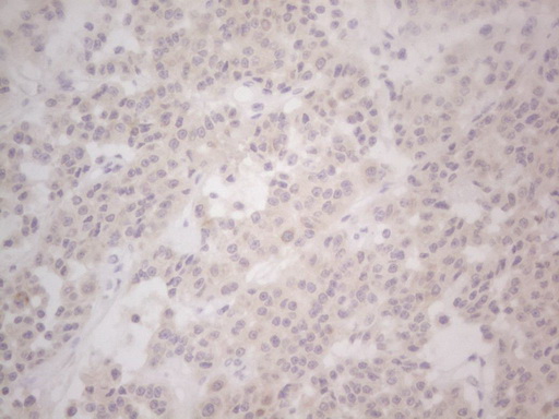 LPIN1 / Lipin 1 Antibody - Immunohistochemical staining of paraffin-embedded Carcinoma of Human lung tissue using anti-LPIN1 mouse monoclonal antibody. (Heat-induced epitope retrieval by Tris-EDTA, pH8.0) Dilution: 1:150