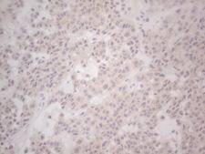 LPIN1 / Lipin 1 Antibody - Immunohistochemical staining of paraffin-embedded Carcinoma of Human lung tissue using anti-LPIN1 mouse monoclonal antibody. (Heat-induced epitope retrieval by Tris-EDTA, pH8.0) Dilution: 1:150