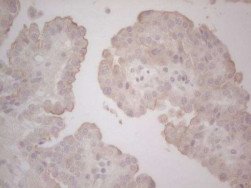 LPIN1 / Lipin 1 Antibody - Immunohistochemical staining of paraffin-embedded Adenocarcinoma of Human ovary tissue using anti-LPIN1 mouse monoclonal antibody. (Heat-induced epitope retrieval by Tris-EDTA, pH8.0) Dilution: 1:150