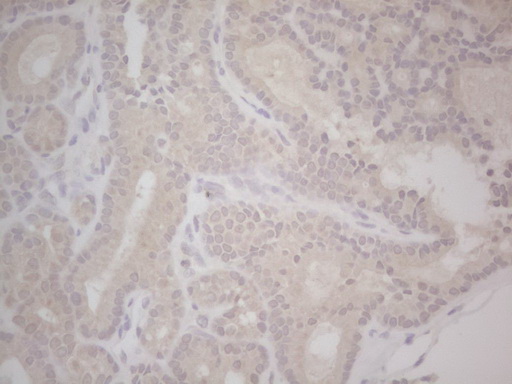 LPIN1 / Lipin 1 Antibody - Immunohistochemical staining of paraffin-embedded Carcinoma of Human thyroid tissue using anti-LPIN1 mouse monoclonal antibody. (Heat-induced epitope retrieval by Tris-EDTA, pH8.0) Dilution: 1:150