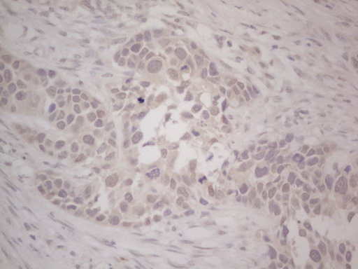 LPIN1 / Lipin 1 Antibody - Immunohistochemical staining of paraffin-embedded Carcinoma of Human kidney tissue using anti-LPIN1 mouse monoclonal antibody. (Heat-induced epitope retrieval by Tris-EDTA, pH8.0) Dilution: 1:150