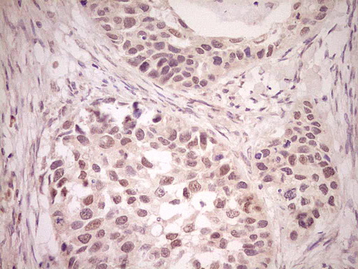 LPIN1 / Lipin 1 Antibody - Immunohistochemical staining of paraffin-embedded Carcinoma of Human kidney tissue using anti-LPIN1 mouse monoclonal antibody. (Heat-induced epitope retrieval by Tris-EDTA, pH8.0) Dilution: 1:150