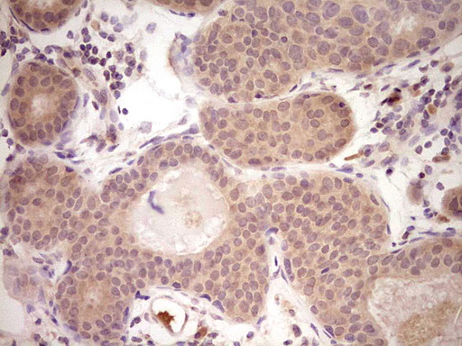 LPIN1 / Lipin 1 Antibody - Immunohistochemical staining of paraffin-embedded Adenocarcinoma of Human breast tissue using anti-LPIN1 mouse monoclonal antibody. (Heat-induced epitope retrieval by Tris-EDTA, pH8.0) Dilution: 1:150