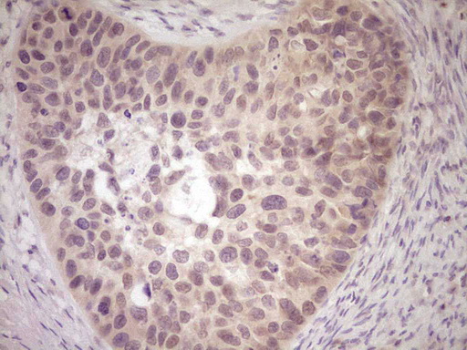 LPIN1 / Lipin 1 Antibody - Immunohistochemical staining of paraffin-embedded Carcinoma of Human kidney tissue using anti-LPIN1 mouse monoclonal antibody. (Heat-induced epitope retrieval by Tris-EDTA, pH8.0) Dilution: 1:150