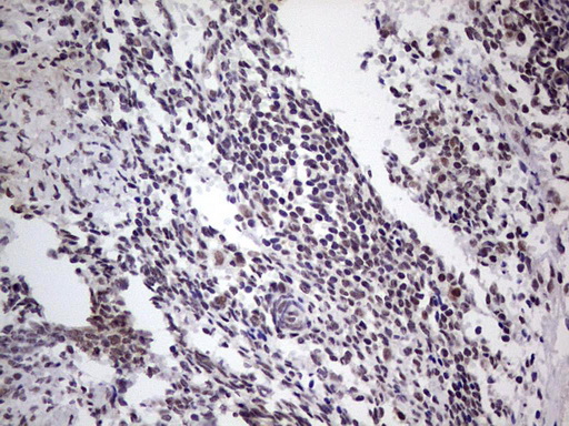 LPIN1 / Lipin 1 Antibody - Immunohistochemical staining of paraffin-embedded Adenocarcinoma of Human endometrium tissue using anti-LPIN1 mouse monoclonal antibody. (Heat-induced epitope retrieval by 1 mM EDTA in 10mM Tris, pH8.5, 120C for 3min,