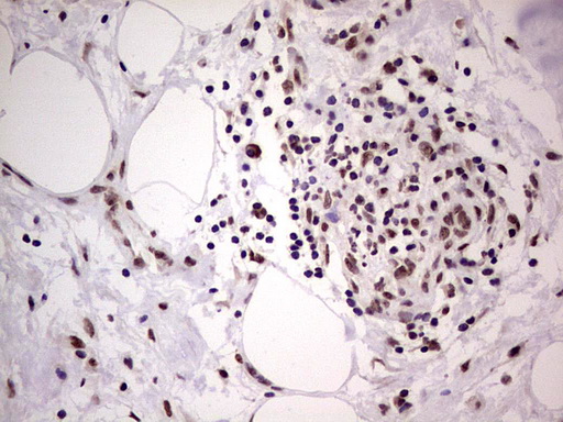 LPIN1 / Lipin 1 Antibody - Immunohistochemical staining of paraffin-embedded Carcinoma of Human bladder tissue using anti-LPIN1 mouse monoclonal antibody. (Heat-induced epitope retrieval by 1 mM EDTA in 10mM Tris, pH8.5, 120C for 3min,