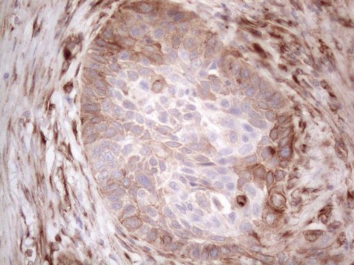 LPIN1 / Lipin 1 Antibody - Immunohistochemical staining of paraffin-embedded Carcinoma of Human lung tissue using anti-LPIN1 mouse monoclonal antibody. (Heat-induced epitope retrieval by 1mM EDTA in 10mM Tris buffer. (pH8.5) at 120°C for 3 min. (1:150)