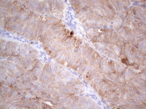 LPIN1 / Lipin 1 Antibody - Immunohistochemical staining of paraffin-embedded Adenocarcinoma of Human ovary tissue using anti-LPIN1 mouse monoclonal antibody. (Heat-induced epitope retrieval by 1mM EDTA in 10mM Tris buffer. (pH8.5) at 120°C for 3 min. (1:150)