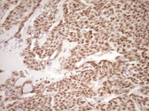 LPIN1 / Lipin 1 Antibody - Immunohistochemical staining of paraffin-embedded Carcinoma of Human lung tissue using anti-LPIN1 mouse monoclonal antibody. (Heat-induced epitope retrieval by 1 mM EDTA in 10mM Tris, pH8.5, 120C for 3min,