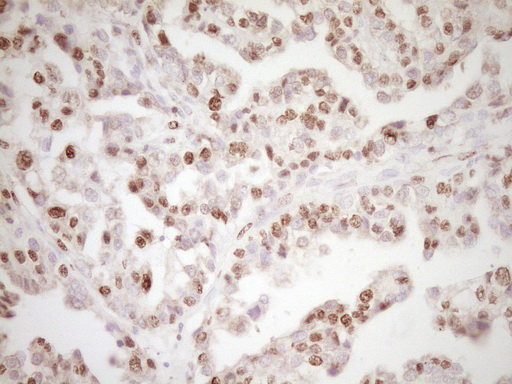 LPIN1 / Lipin 1 Antibody - Immunohistochemical staining of paraffin-embedded Adenocarcinoma of Human ovary tissue using anti-LPIN1 mouse monoclonal antibody. (Heat-induced epitope retrieval by 1 mM EDTA in 10mM Tris, pH8.5, 120C for 3min,