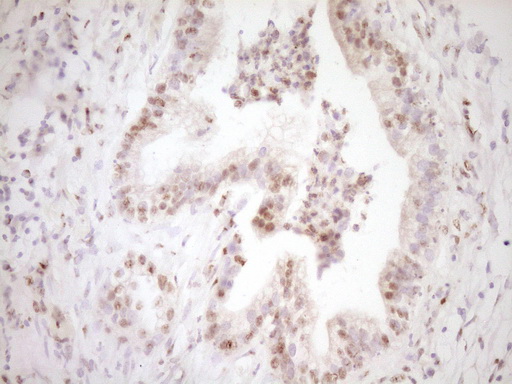 LPIN1 / Lipin 1 Antibody - Immunohistochemical staining of paraffin-embedded Carcinoma of Human pancreas tissue using anti-LPIN1 mouse monoclonal antibody. (Heat-induced epitope retrieval by 1 mM EDTA in 10mM Tris, pH8.5, 120C for 3min,