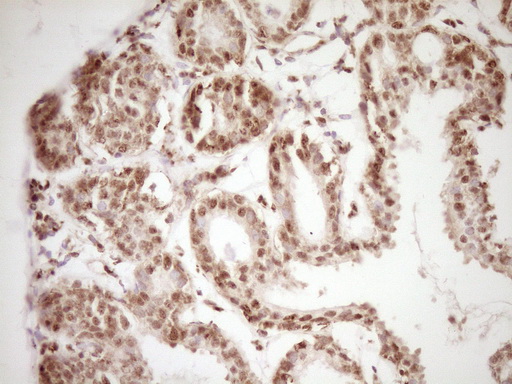 LPIN1 / Lipin 1 Antibody - Immunohistochemical staining of paraffin-embedded Adenocarcinoma of Human breast tissue using anti-LPIN1 mouse monoclonal antibody. (Heat-induced epitope retrieval by 1 mM EDTA in 10mM Tris, pH8.5, 120C for 3min,
