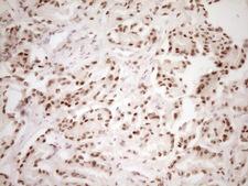 LPIN1 / Lipin 1 Antibody - Immunohistochemical staining of paraffin-embedded Carcinoma of Human prostate tissue using anti-LPIN1 mouse monoclonal antibody. (Heat-induced epitope retrieval by 1 mM EDTA in 10mM Tris, pH8.5, 120C for 3min,
