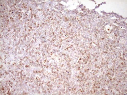 LPIN1 / Lipin 1 Antibody - Immunohistochemical staining of paraffin-embedded Human lymphoma tissue using anti-LPIN1 mouse monoclonal antibody. (Heat-induced epitope retrieval by 1 mM EDTA in 10mM Tris, pH8.5, 120C for 3min,