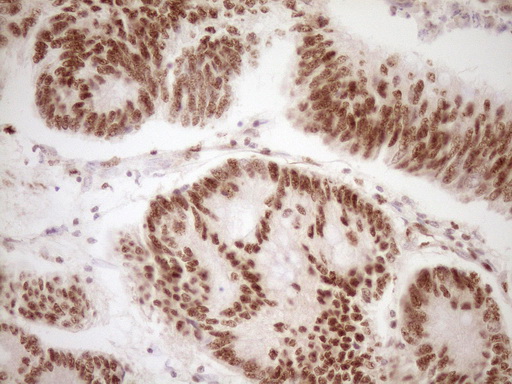 LPIN1 / Lipin 1 Antibody - Immunohistochemical staining of paraffin-embedded Adenocarcinoma of Human colon tissue using anti-LPIN1 mouse monoclonal antibody. (Heat-induced epitope retrieval by 1 mM EDTA in 10mM Tris, pH8.5, 120C for 3min,