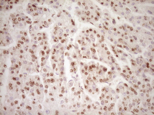 LPIN1 / Lipin 1 Antibody - Immunohistochemical staining of paraffin-embedded Carcinoma of Human liver tissue using anti-LPIN1 mouse monoclonal antibody. (Heat-induced epitope retrieval by 1 mM EDTA in 10mM Tris, pH8.5, 120C for 3min,