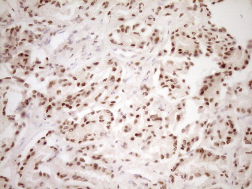 LPIN1 / Lipin 1 Antibody - IHC of paraffin-embedded Carcinoma of Human prostate tissue using anti-LPIN1 mouse monoclonal antibody. (Heat-induced epitope retrieval by 1 mM EDTA in 10mM Tris, pH8.5, 120°C for 3min).