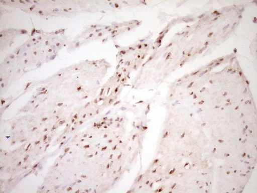 LPIN1 / Lipin 1 Antibody - IHC of paraffin-embedded Carcinoma of Human bladder tissue using anti-LPIN1 mouse monoclonal antibody. (Heat-induced epitope retrieval by 1 mM EDTA in 10mM Tris, pH8.5, 120°C for 3min).
