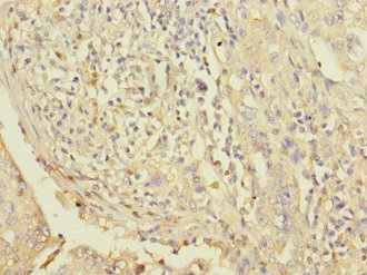 LPIN1 / Lipin 1 Antibody - Immunohistochemistry of paraffin-embedded human lung cancer at dilution 1:100