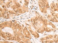 LPIN1 / Lipin 1 Antibody - Immunohistochemistry of paraffin-embedded Human gastric cancer tissue  using LPIN1 Polyclonal Antibody at dilution of 1:60(×200)