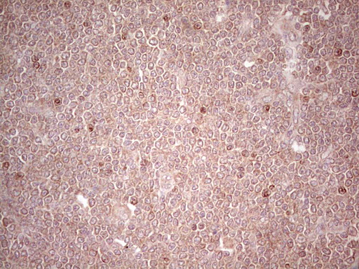 LPIN3 / Lipin-3 Antibody - Immunohistochemical staining of paraffin-embedded Human lymphoma tissue using anti-LPIN3 mouse monoclonal antibody. (Heat-induced epitope retrieval by 1 mM EDTA in 10mM Tris, pH8.5, 120C for 3min,