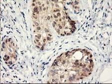 LPL / Lipoprotein Lipase Antibody - IHC of paraffin-embedded Adenocarcinoma of Human breast tissue using anti-LPL mouse monoclonal antibody.