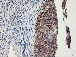 LPL / Lipoprotein Lipase Antibody - IHC of paraffin-embedded Adenocarcinoma of Human ovary tissue using anti-LPL mouse monoclonal antibody.