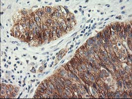 LPL / Lipoprotein Lipase Antibody - IHC of paraffin-embedded Carcinoma of Human bladder tissue using anti-LPL mouse monoclonal antibody.